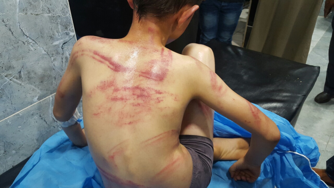 به‌ وێنه‌.. منداڵێكى 10 ساڵان به‌م جۆره‌ ئه‌شكه‌نجه‌ دراوه‌